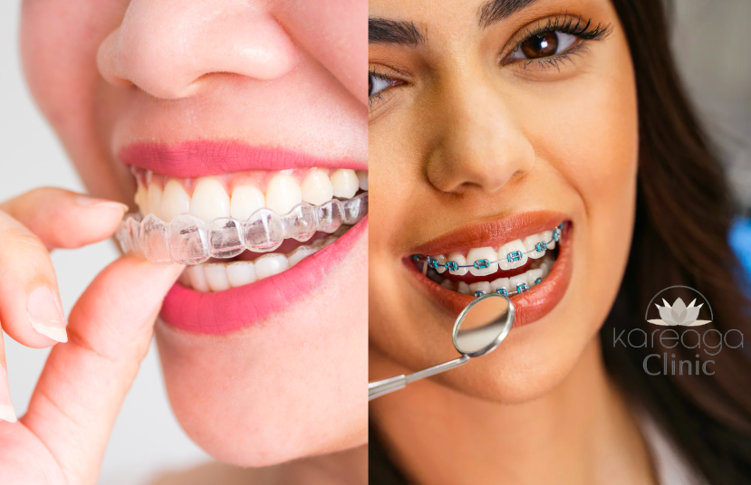 Invisalign vs Brackets Tradicionales